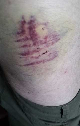 ankylosingspondylitis.co.uk-bruised-hip