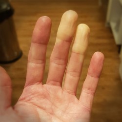 My Raynauds syndrome